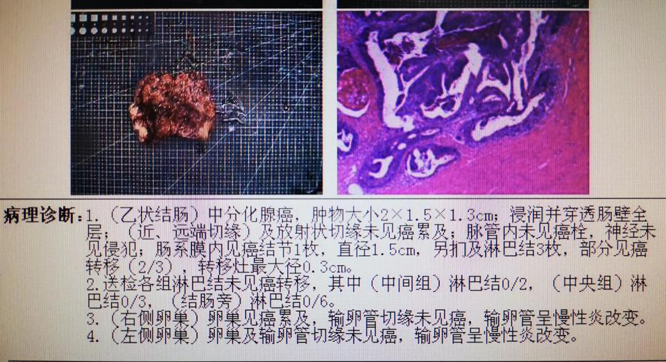 "肠"话短说 陈功教授病例分享:结直肠癌同时性肝转移诊疗新理念