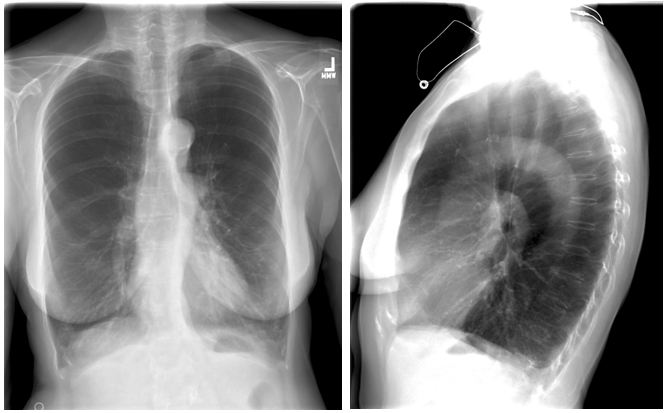 后前位和侧位胸片显示肺气肿