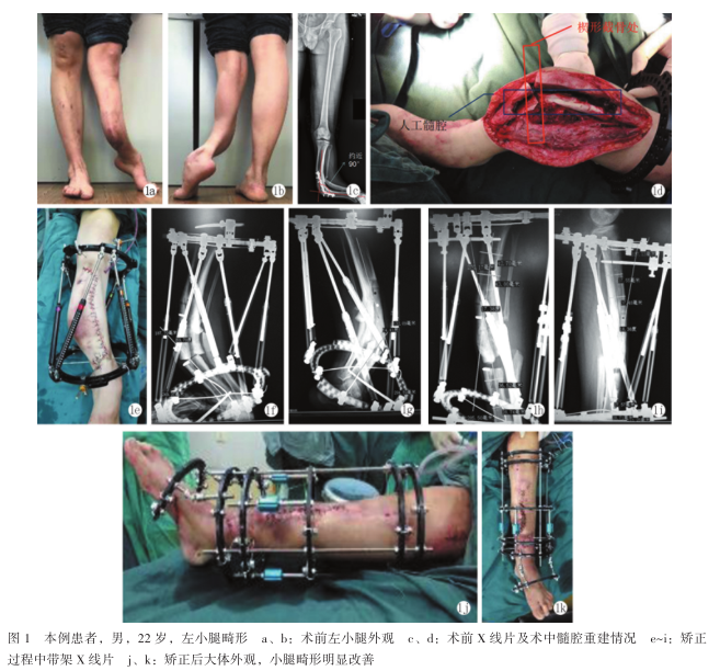 taylor空间外固定架结合ilizarov治疗左小腿畸形1例