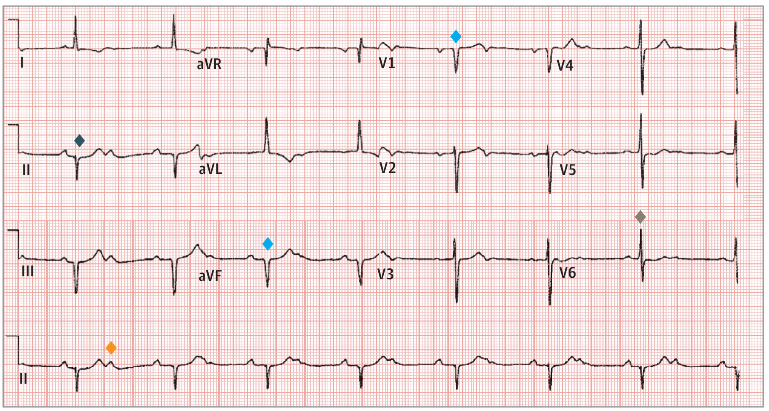 先天性心脏病,心电图上能看出什么?
