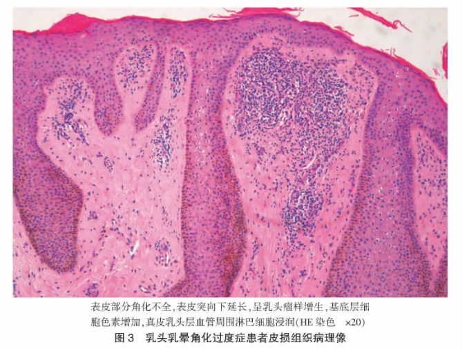皮损组织病理检查:表皮部分角化不全,表皮突向下延长,呈乳头瘤样增生