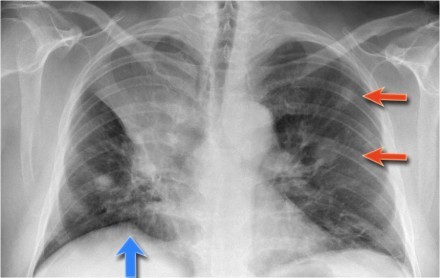 一文总结肺不张的影像学表现丨以影识病