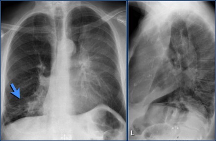 一文总结肺不张的影像学表现丨以影识病