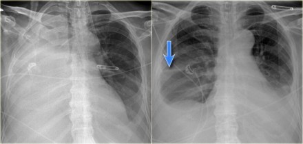 右图为插管吸引治疗后,随访胸片见右肺复张 纵膈位置恢复 一侧全肺不