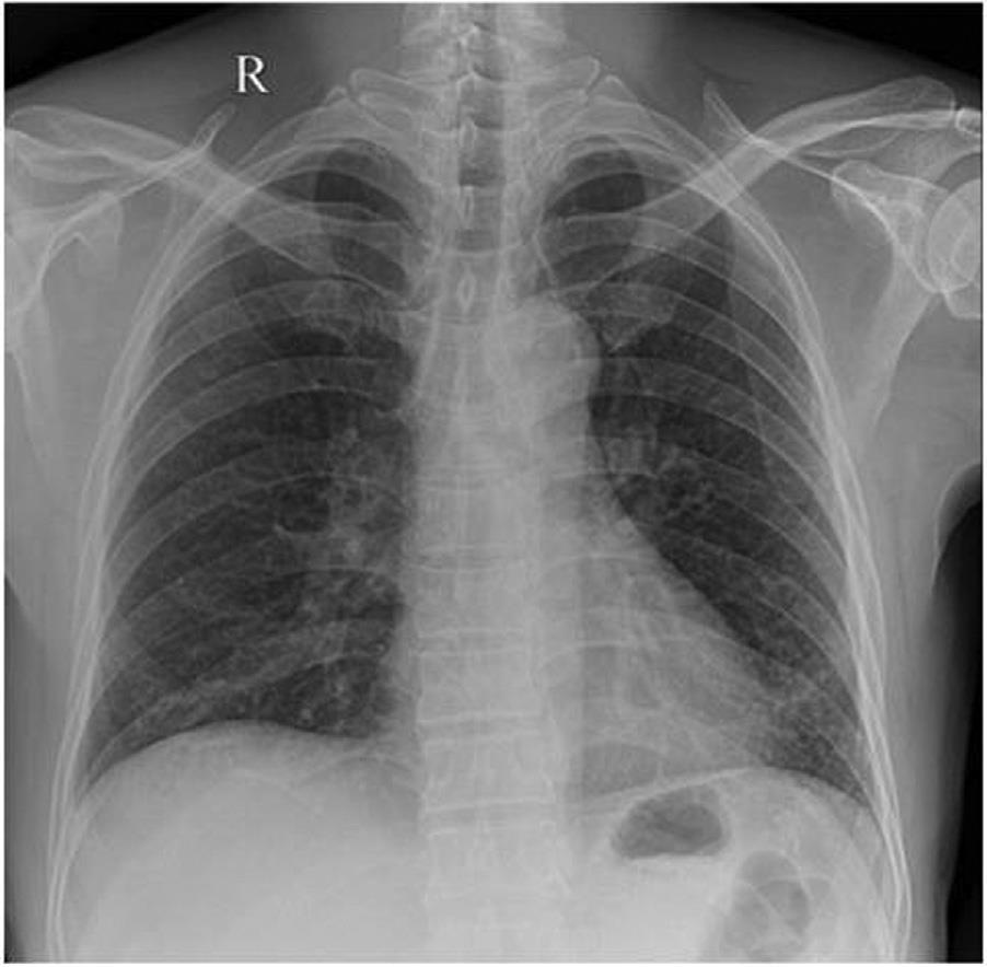 图1 胸片显示左下肺阴影