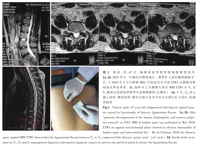 针刀治疗胸椎管狭窄症1例