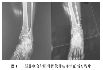 下胫腓联合部腓骨骨软骨瘤1例