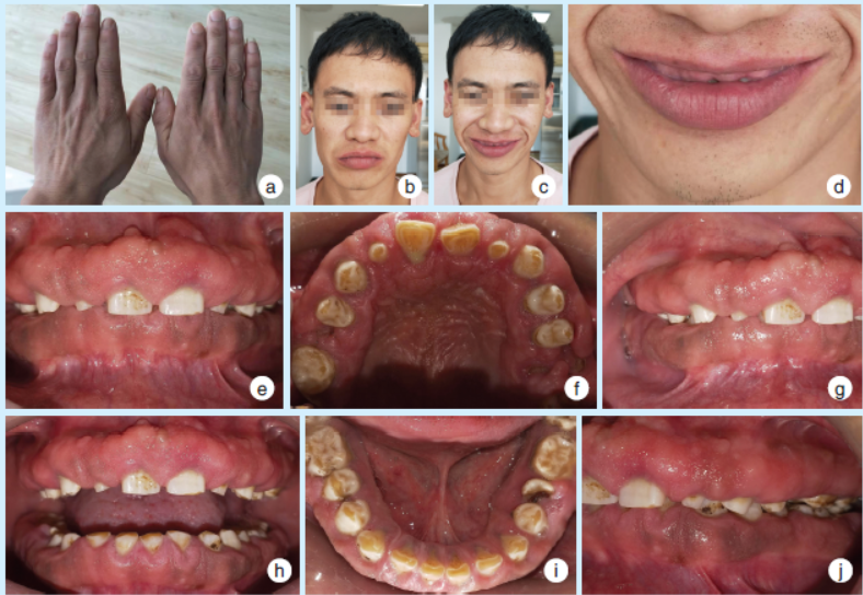 特发性牙龈纤维瘤病病例报道及文献回顾