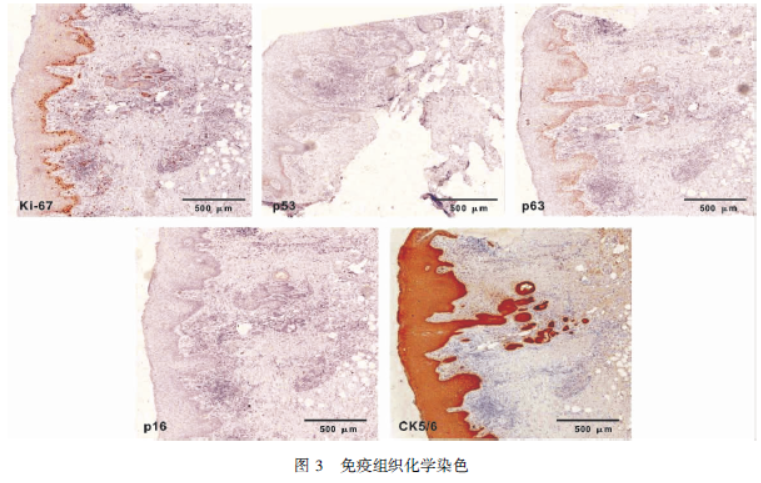 坏死性唾液腺化生1例