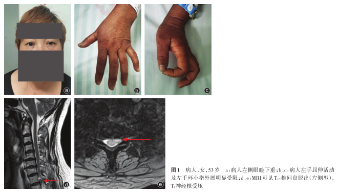 胸12椎间盘突出并发horner综合征一例