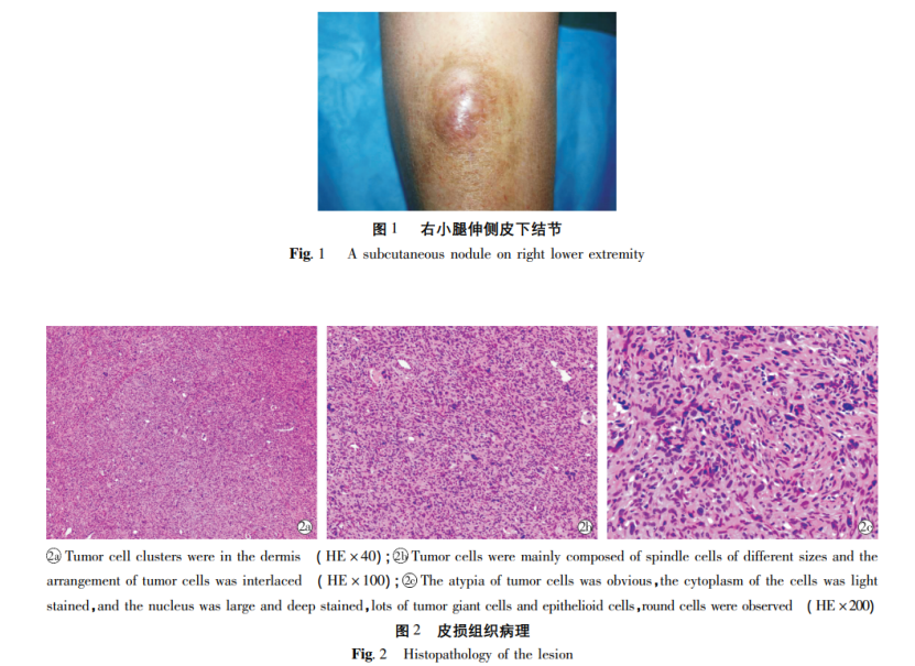undifferentiated pleomorphic sarcoma,ups) ,由恶性纤维组织细胞瘤