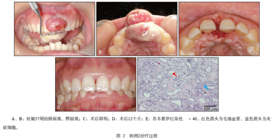 不同特点妊娠期牙龈瘤的治疗体会