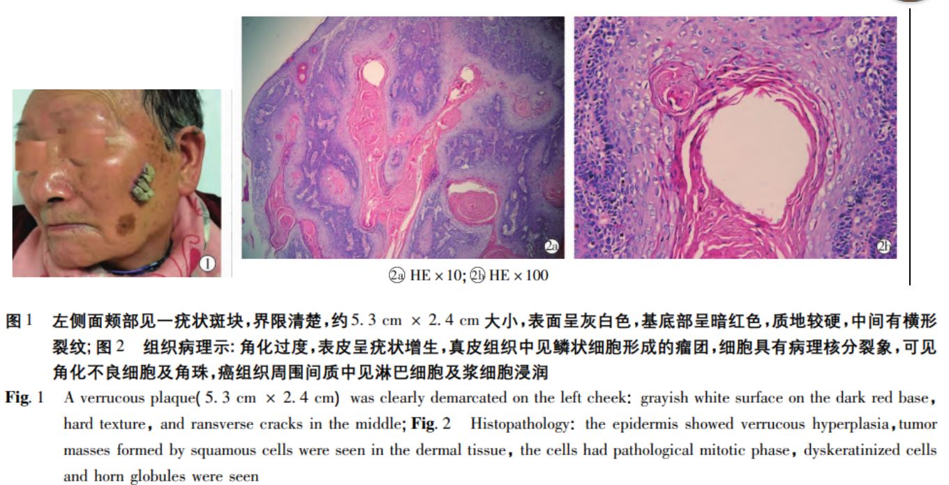 面部疣状癌1例