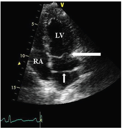 胸腔(图1)和食管(图2)的超声心动图显示其患有非梗阻性三房心.