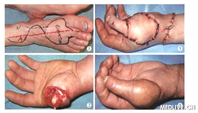 静脉动脉化第2足趾移植再造拇指成功一例