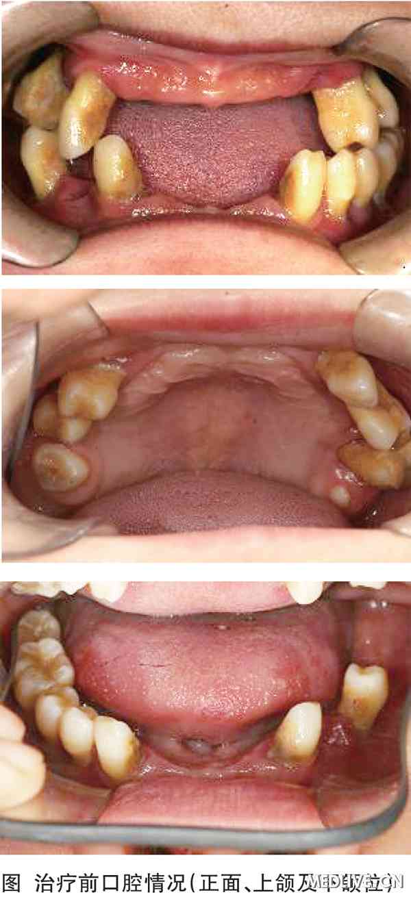 中度牙周炎图片