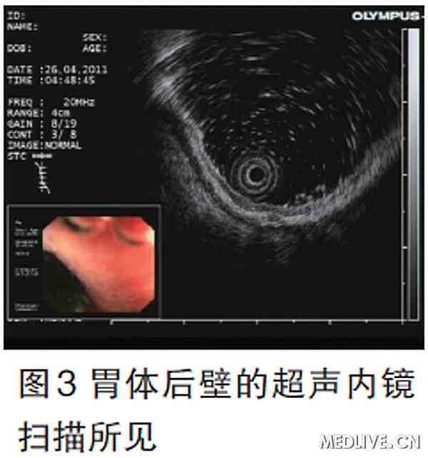 胃体后壁的超声内镜扫描所见