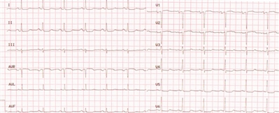 心电图:广泛导联st段轻度压低,v1呈qs型,v2呈rs型