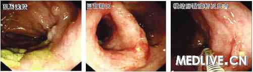 肠结核肠镜图片