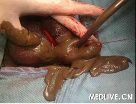 三睾丸患者发生以睾丸扭转为临床表现的表皮囊肿