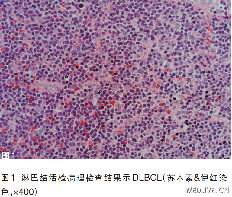 弥漫大B细胞淋巴瘤的早期症状是什么？