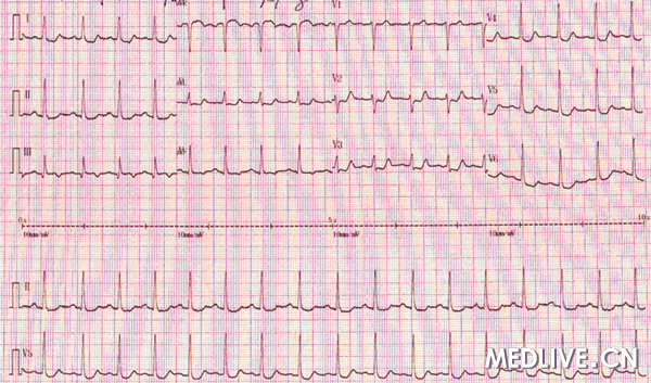 图1 患者突发胸痛时的心电图表现