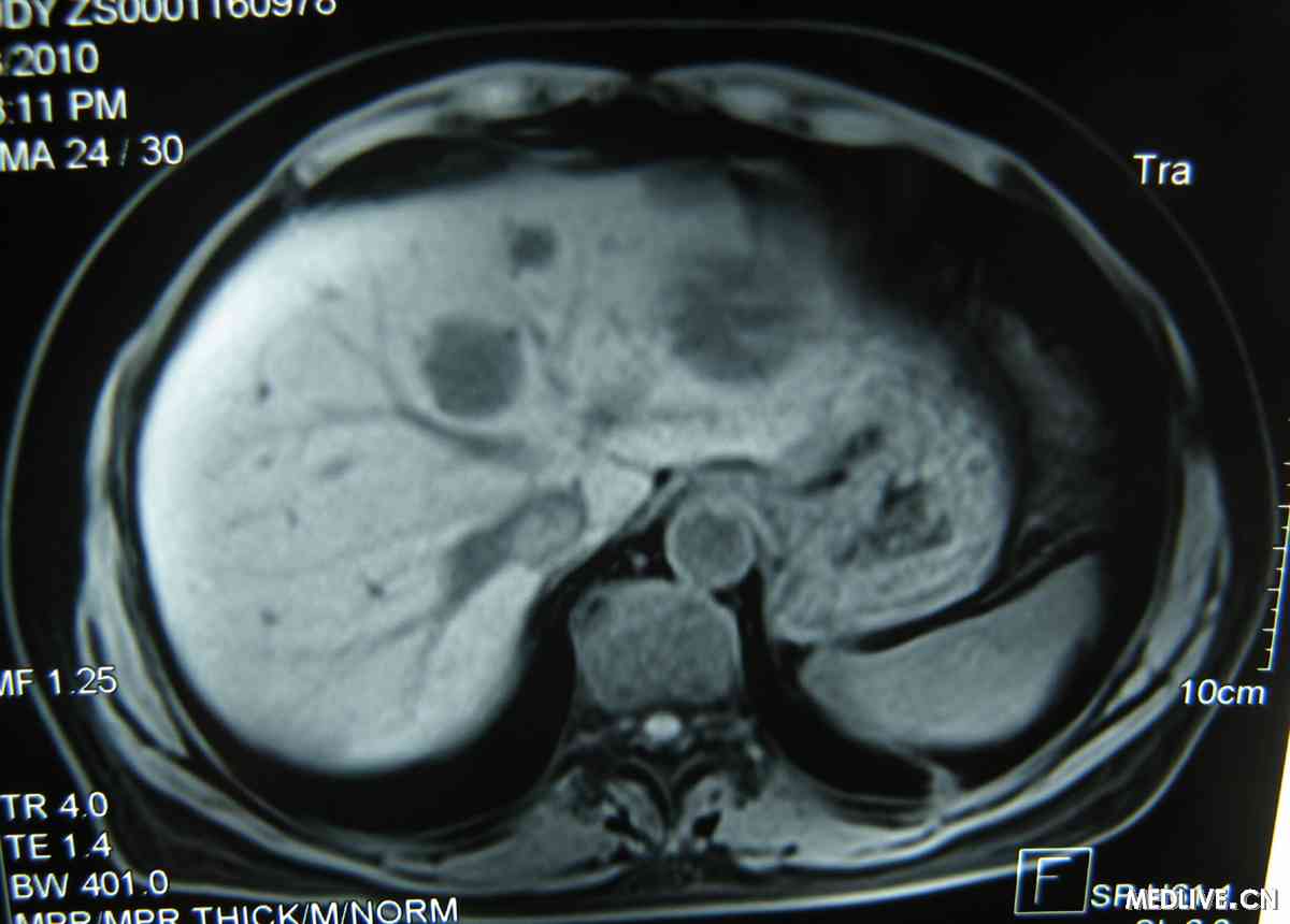 肝豆状核变性合并肝细胞癌1例报告
