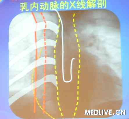 2011长城会罕见病例经桡动脉造影导致右乳内动脉穿孔