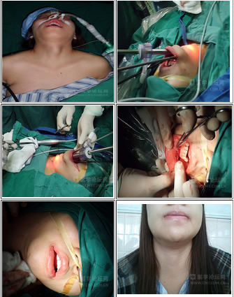 前庭大腺炎手术过程图片