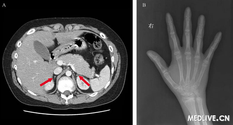 上腹部ct:双侧肾上腺萎缩(箭头所示)b