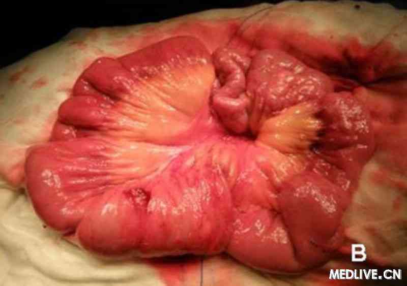 肠道脂肪瘤图片