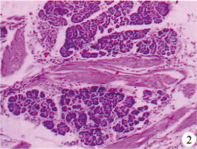 异位胰腺图片图片
