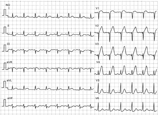 容易忽略的急性心肌梗死心电图
