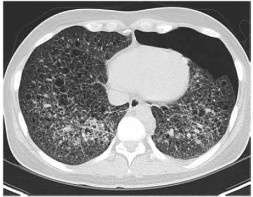 图2a  轴向胸部ct肺窗显示双侧肺多发囊肿,壁较薄,双侧肺底部实质毛