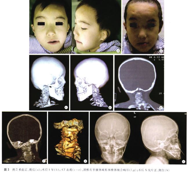 面-耳-椎综合征二例