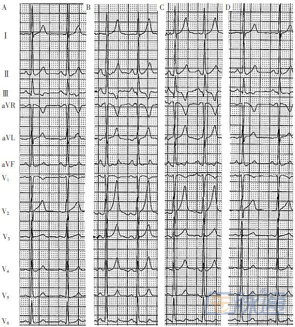 卢喜烈:高耸t波的九种情况及心电图特征