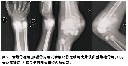 左股骨远端骨肉瘤图片
