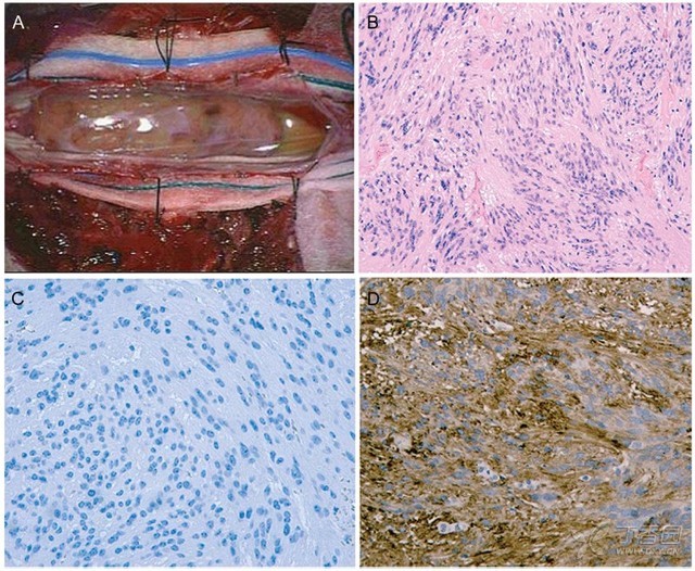 但是,组织病理学检查最终将诊断修正为伸长细胞型室管膜瘤(图2),该型