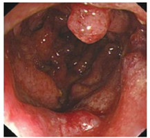 检查,进镜70cm至回肠末端5cm,横结肠肝曲以远黏膜弥漫性显著充血水肿
