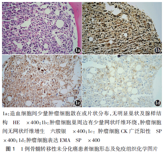 形态特殊的骨髓转移性未分化癌一例