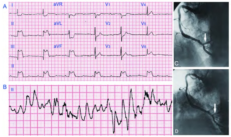 右冠状动脉痉挛时的心电图表现