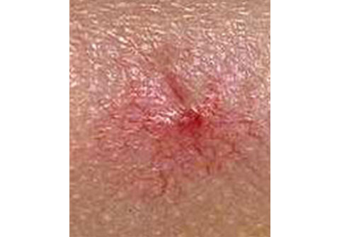 蜘蛛状血管瘤或蜘蛛痣,是发现于晚期肝病的浅表血管肿