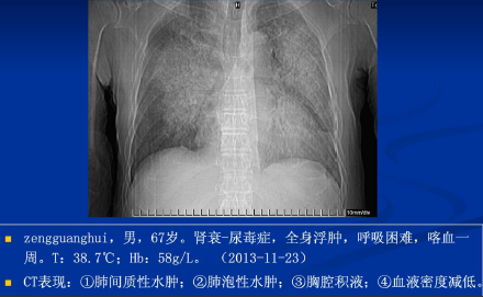 不同类型肺水肿的ct表现(下)