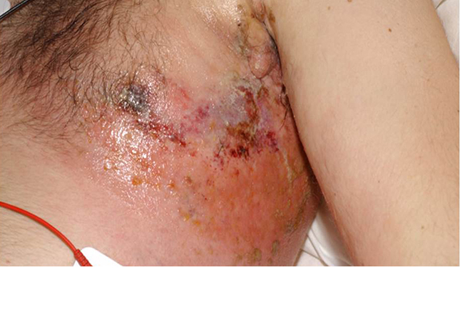图文:6个病例教你识别化疗引发的皮肤病变