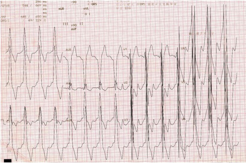 男性患者,17岁,因活动后心悸伴乏力2年入院,心电图示左室高电压伴