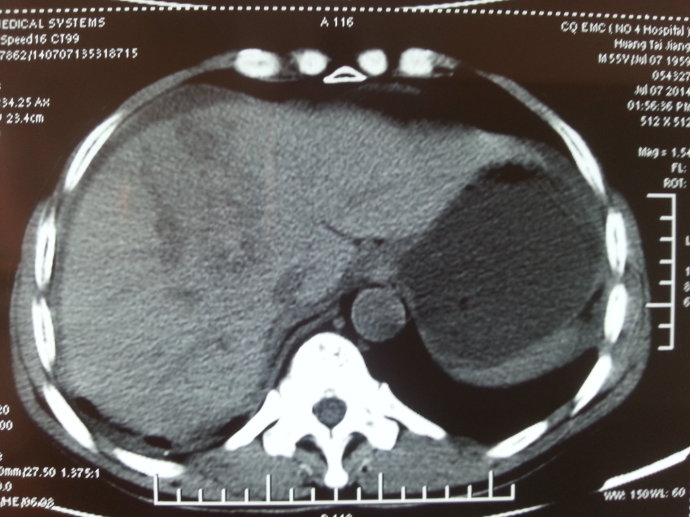 肝破裂ct图片