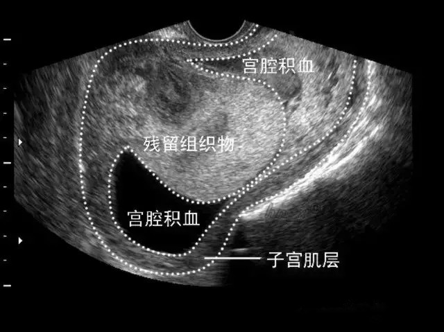 彩超表现:妊娠囊内无胎心搏动信号,仍可记录到低阻力的滋养层血流