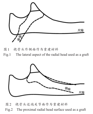 尺骨冠突損傷的重建策略研究進展