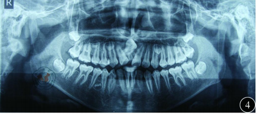 埋伏牙伴多生牙四颗一例