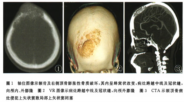 头颅ct平扫示:额骨及右侧顶骨膨胀性骨质破坏,ct值约57～651hu,其内呈